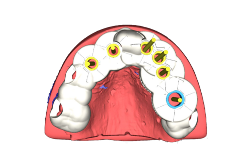 Guided Surgery 3