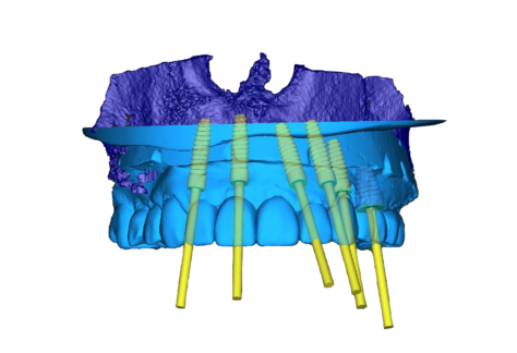 guided surgery, implant, surgical planning