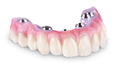 Zirconia Bridge, implants, Full Arch, dental implants, Ottawa Dental Laboratory