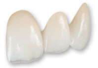 Full Ceramic, dental crown,, bridge, dental crowns, dental bridge, all ceramic